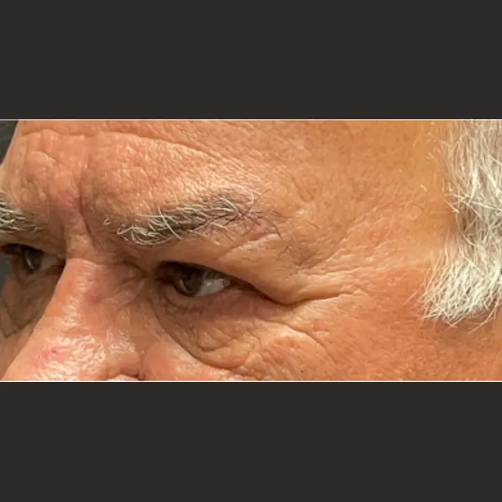 After: blepharoplasty