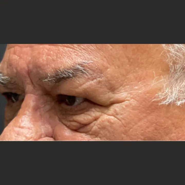 Before: blepharoplasty