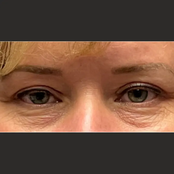 After: blepharoplasty