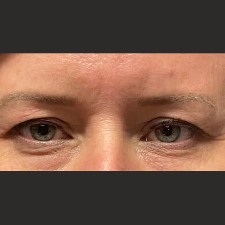 Before: blepharoplasty