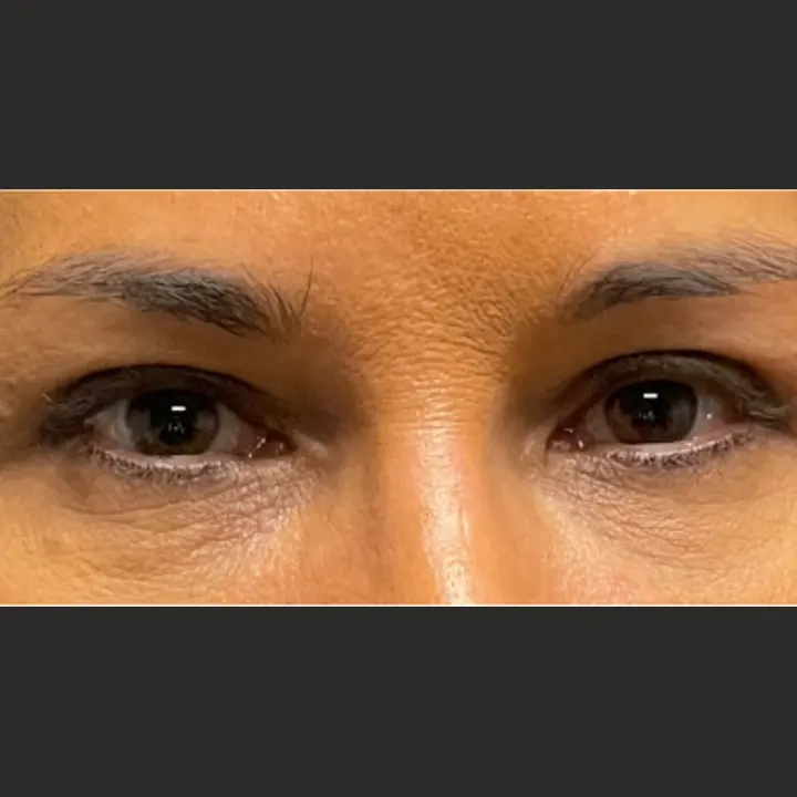 After: blepharoplasty