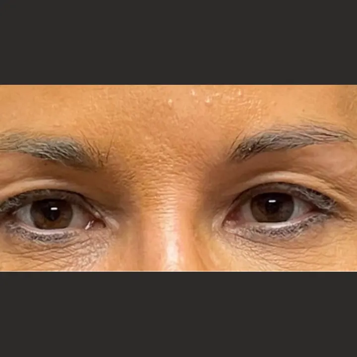 Before: blepharoplasty