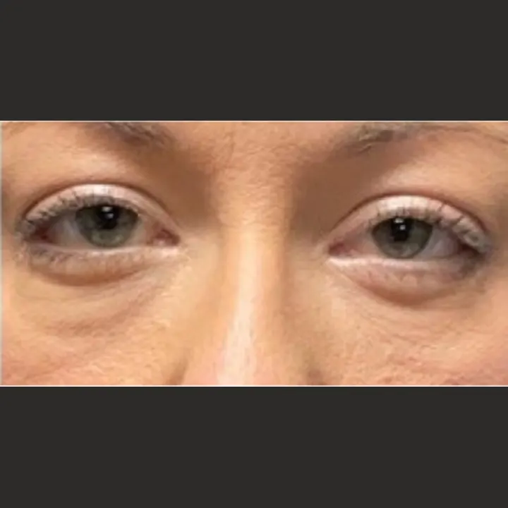 After: blepharoplasty