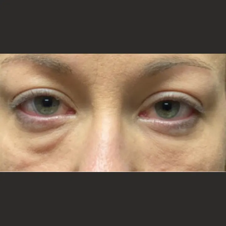 Before: blepharoplasty
