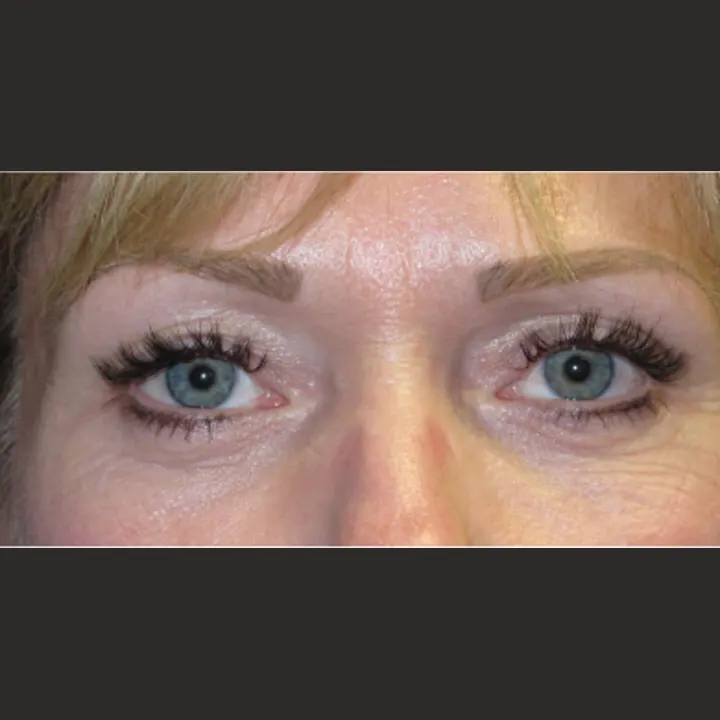 After: blepharoplasty