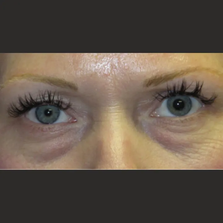 Before: blepharoplasty