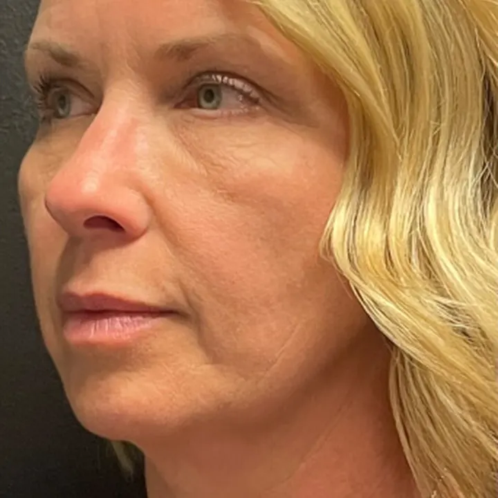 After: brow lift and lower lids