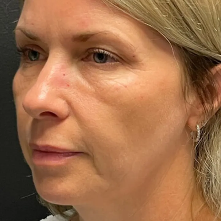 Before: brow lift and lower lids