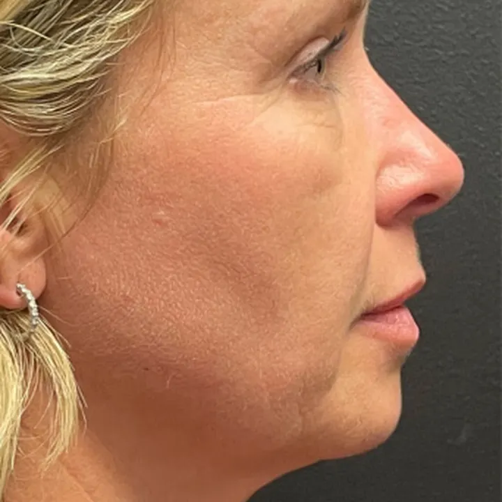 After: brow lift and lower lids