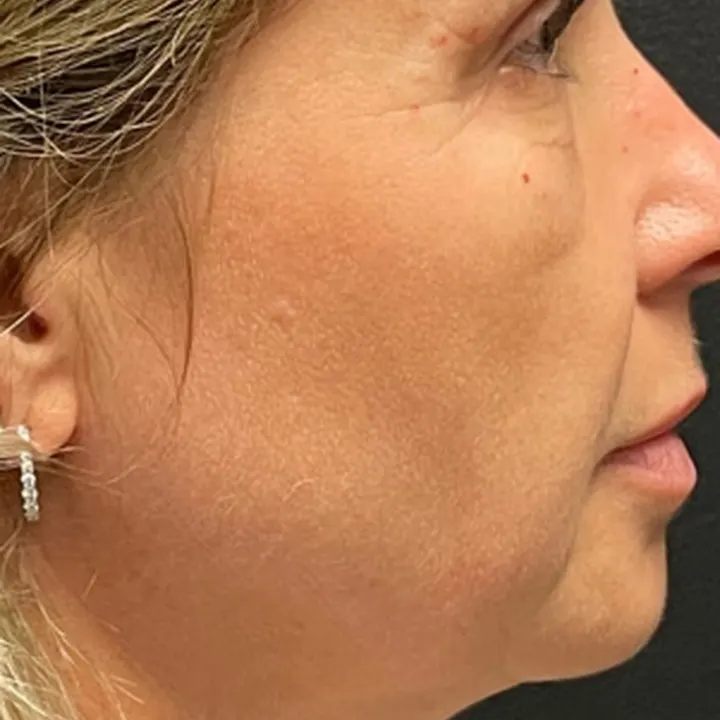 Before: brow lift and lower lids