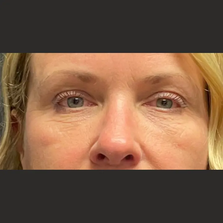 After: brow lift and lower lids