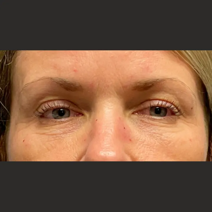 Before: brow lift and lower lids