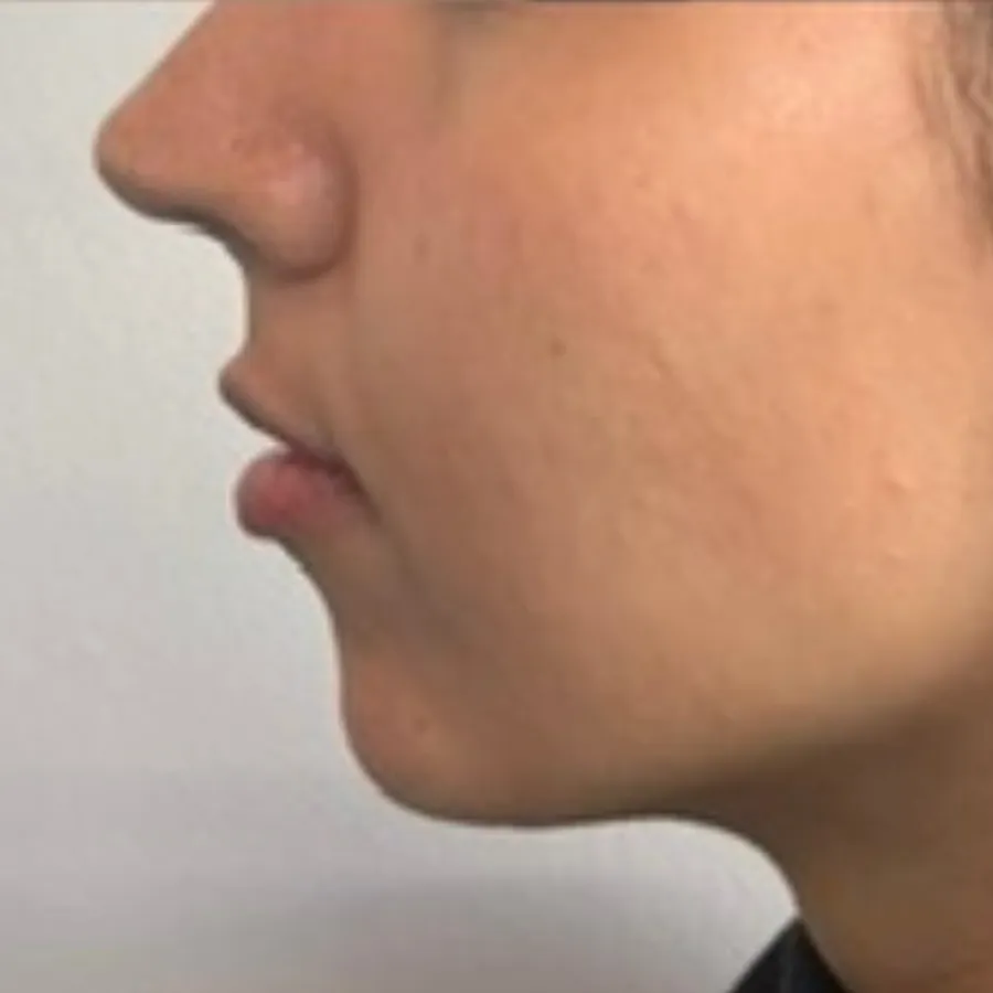 After: chin filler