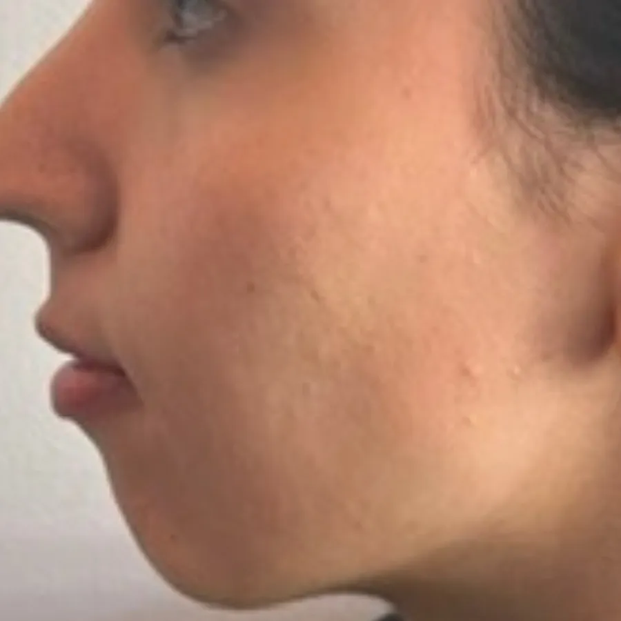 Before: chin filler