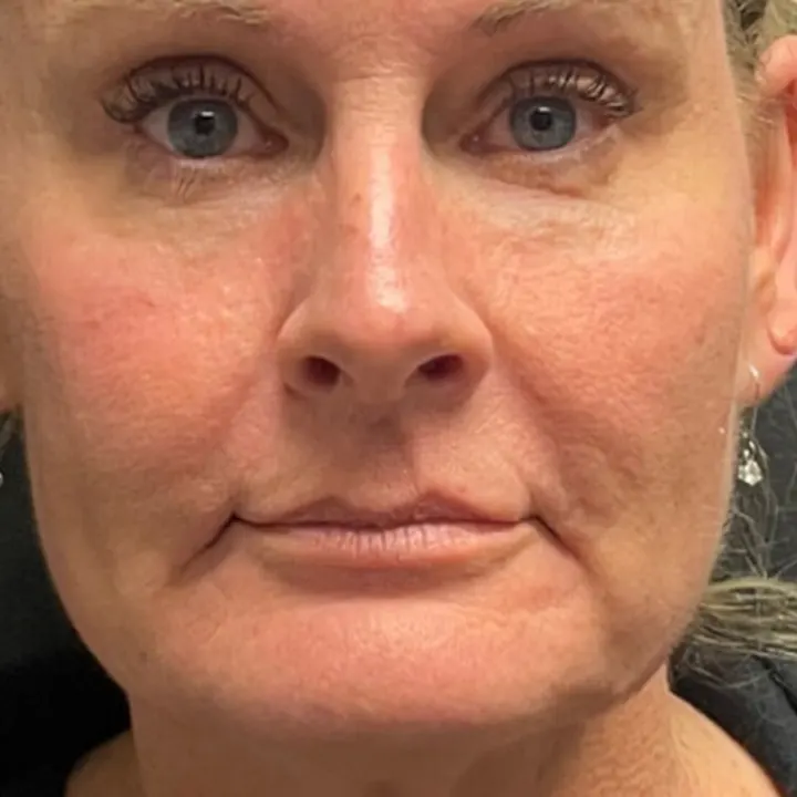 After: face and neck lift