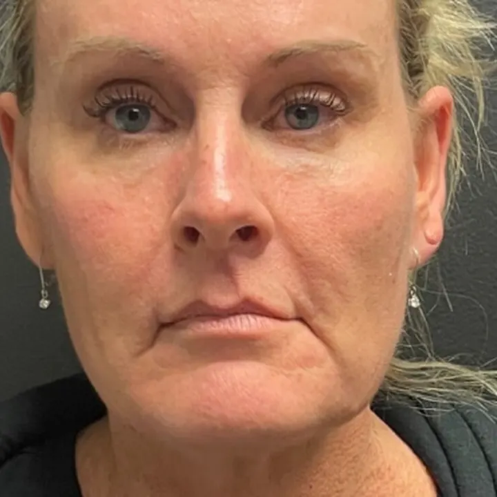 Before: face and neck lift