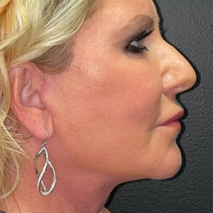 After: face and neck lift