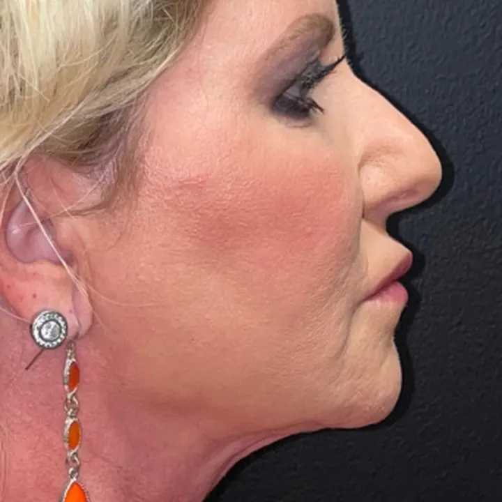 Before: face and neck lift