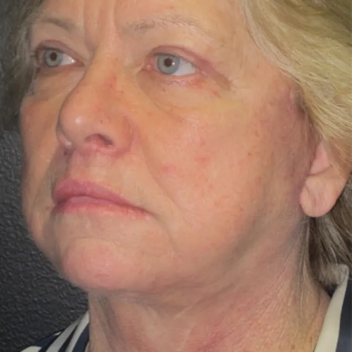 After: face and neck lift