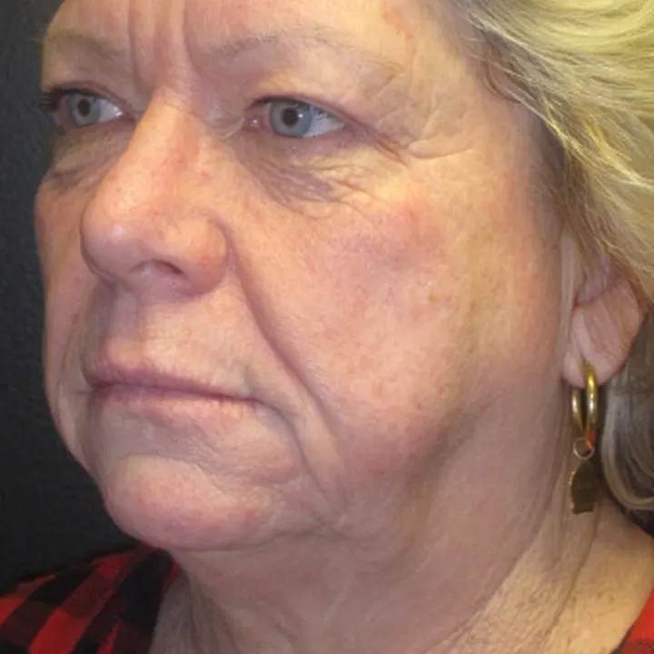 Before: face and neck lift