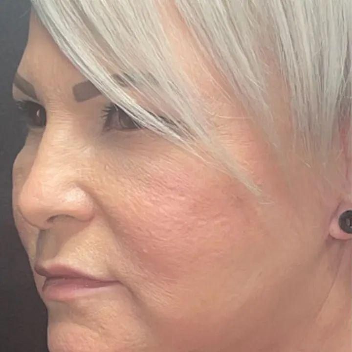 After: face and neck lift