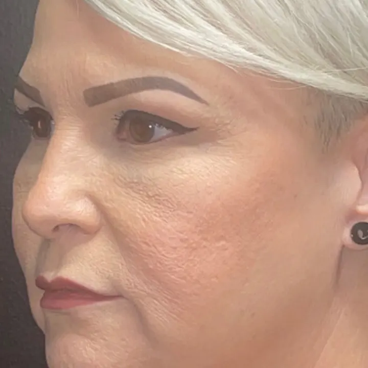 Before: face and neck lift