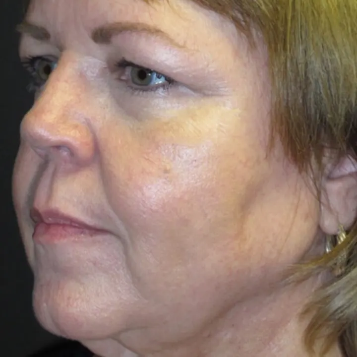 After: face and neck lift