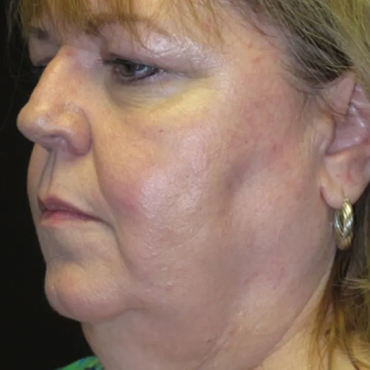 Before: face and neck lift