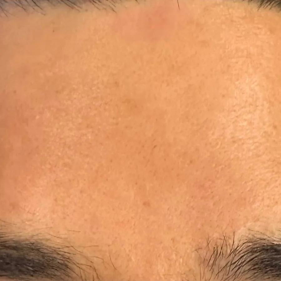 After: wrinkle relaxer