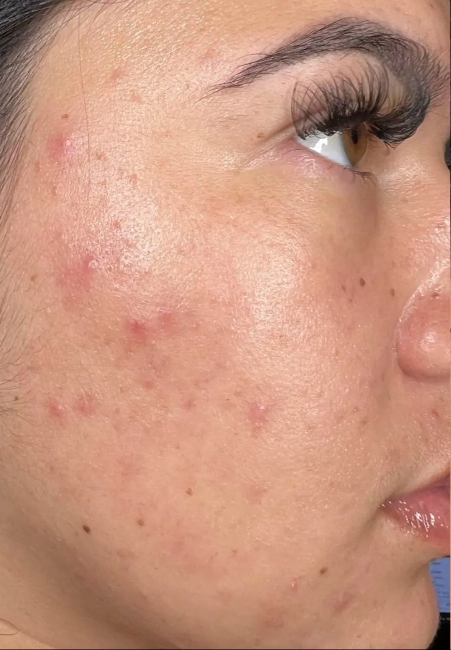 Before: breakouts and redness