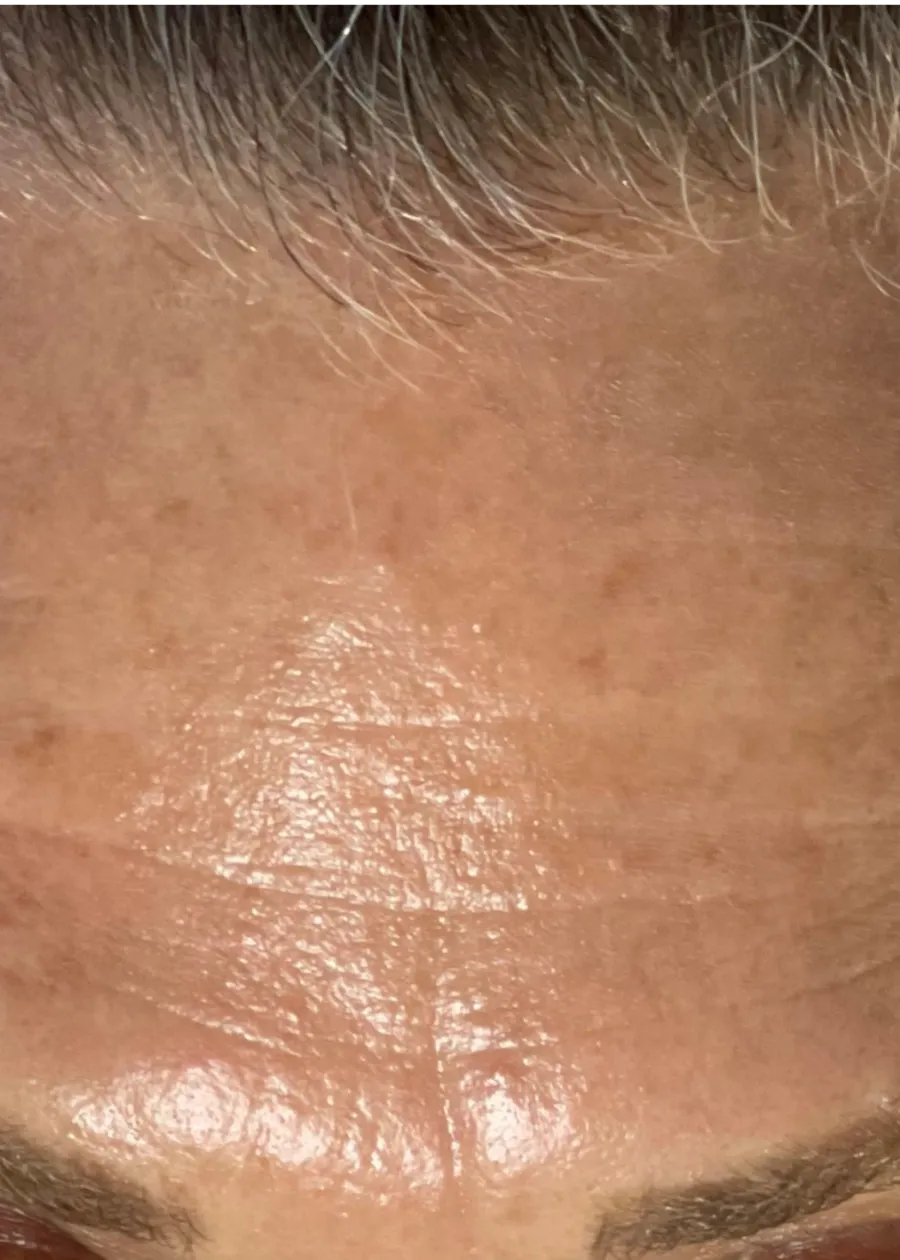 After: forehead lines