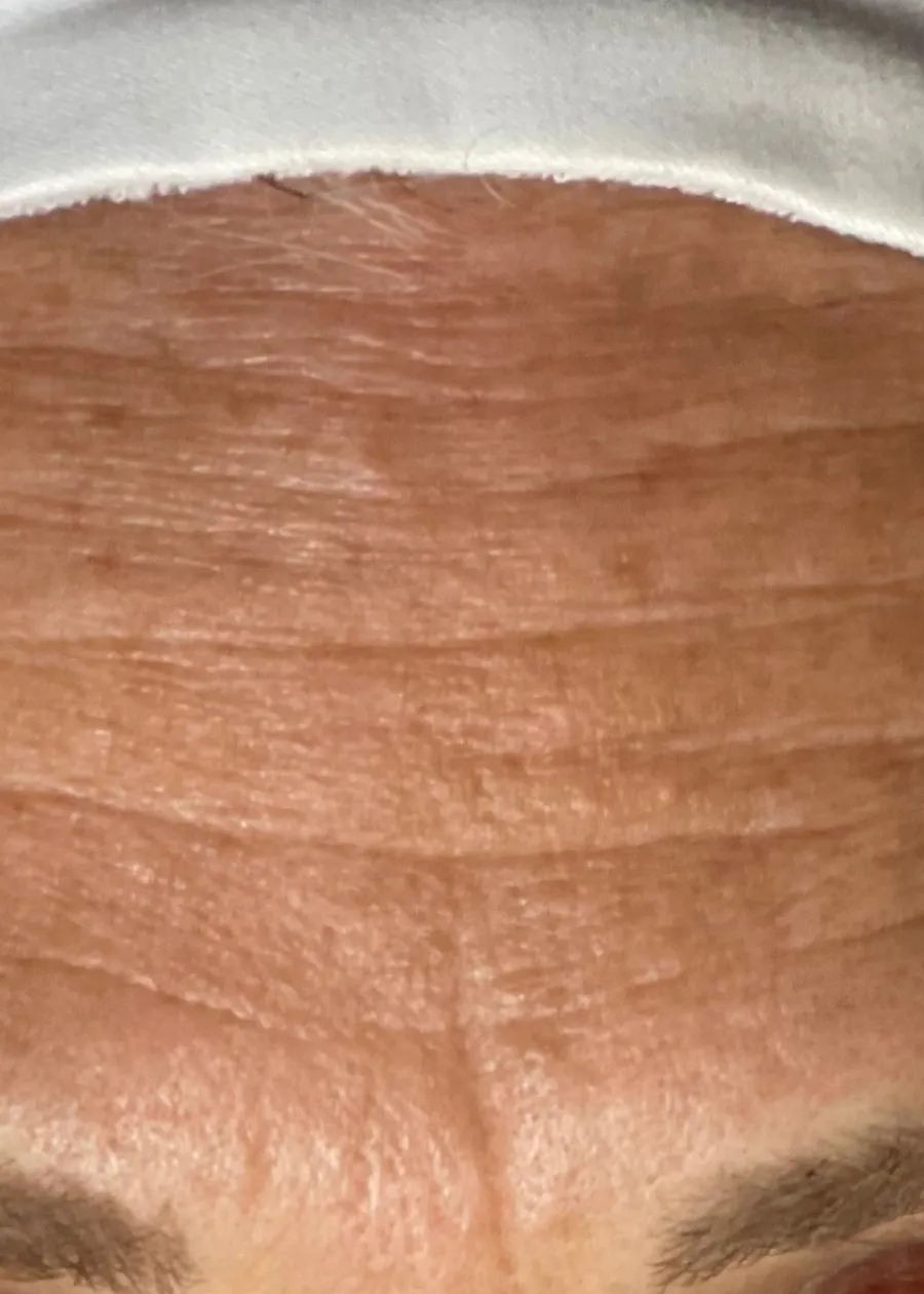 Before: forehead lines