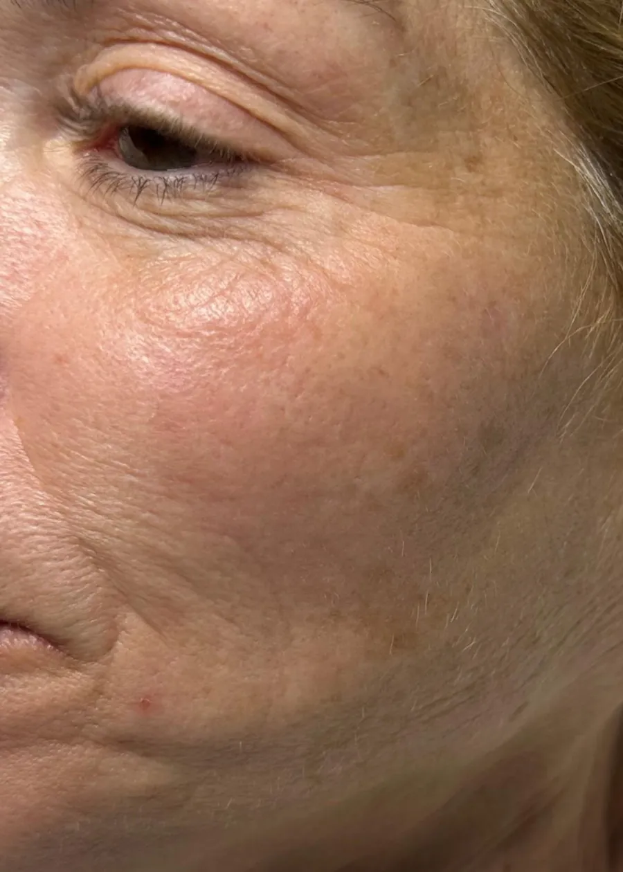 Before: fine lines and texture