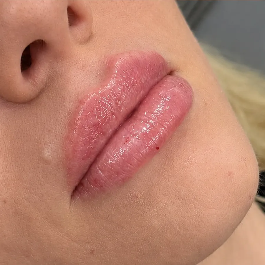 After: lip filler