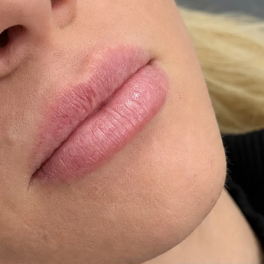 Before: lip filler
