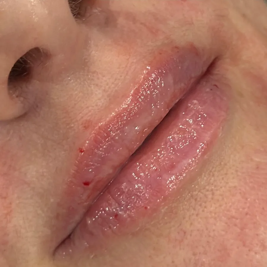 After: lip filler
