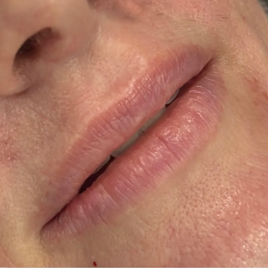 Before: lip filler