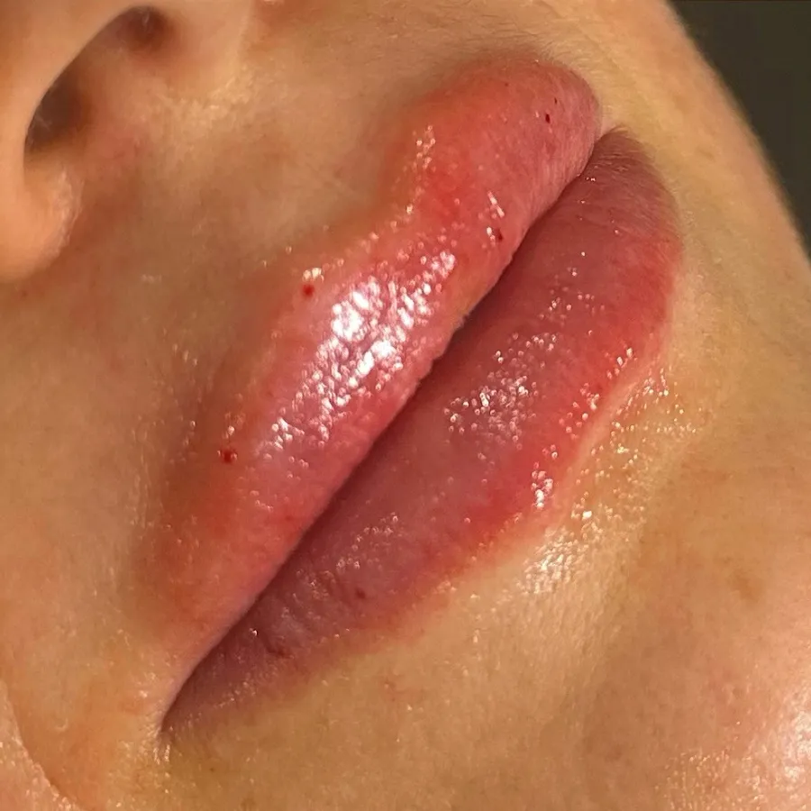 After: lip filler