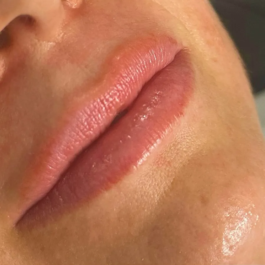 Before: lip filler
