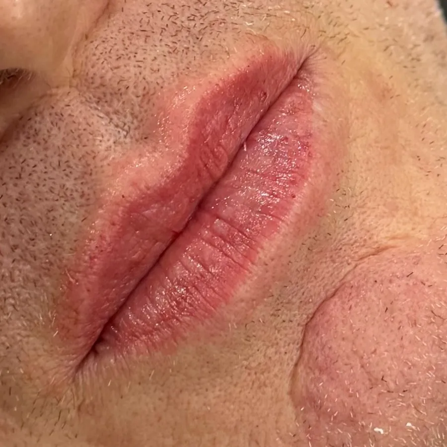 After: lip filler