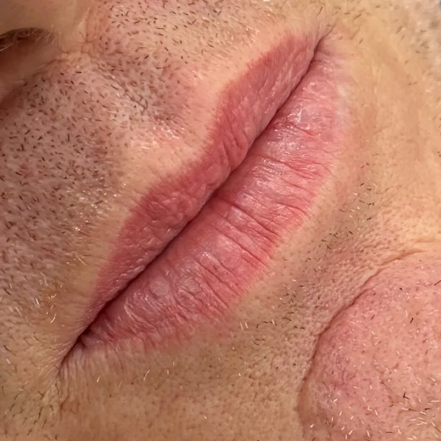 Before: lip filler