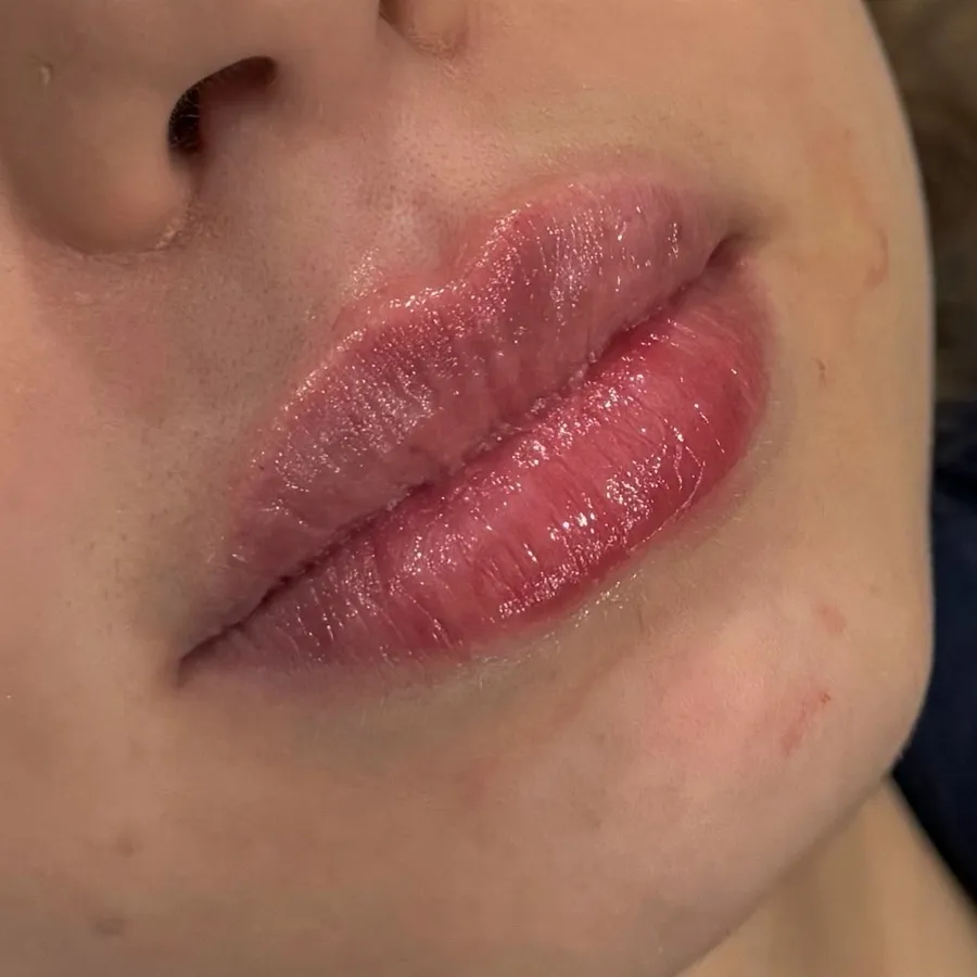 After: lip filler