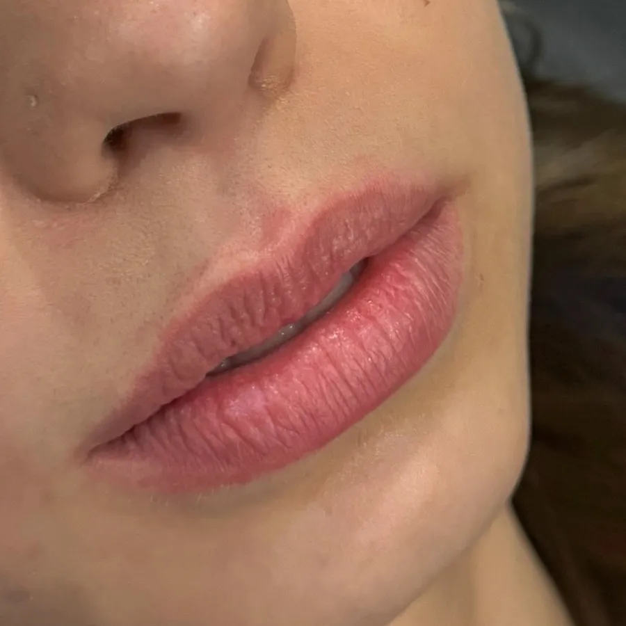 Before: lip filler