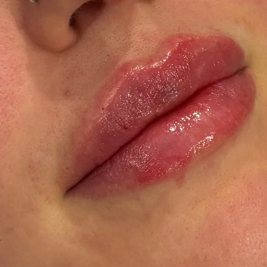 After: lip filler