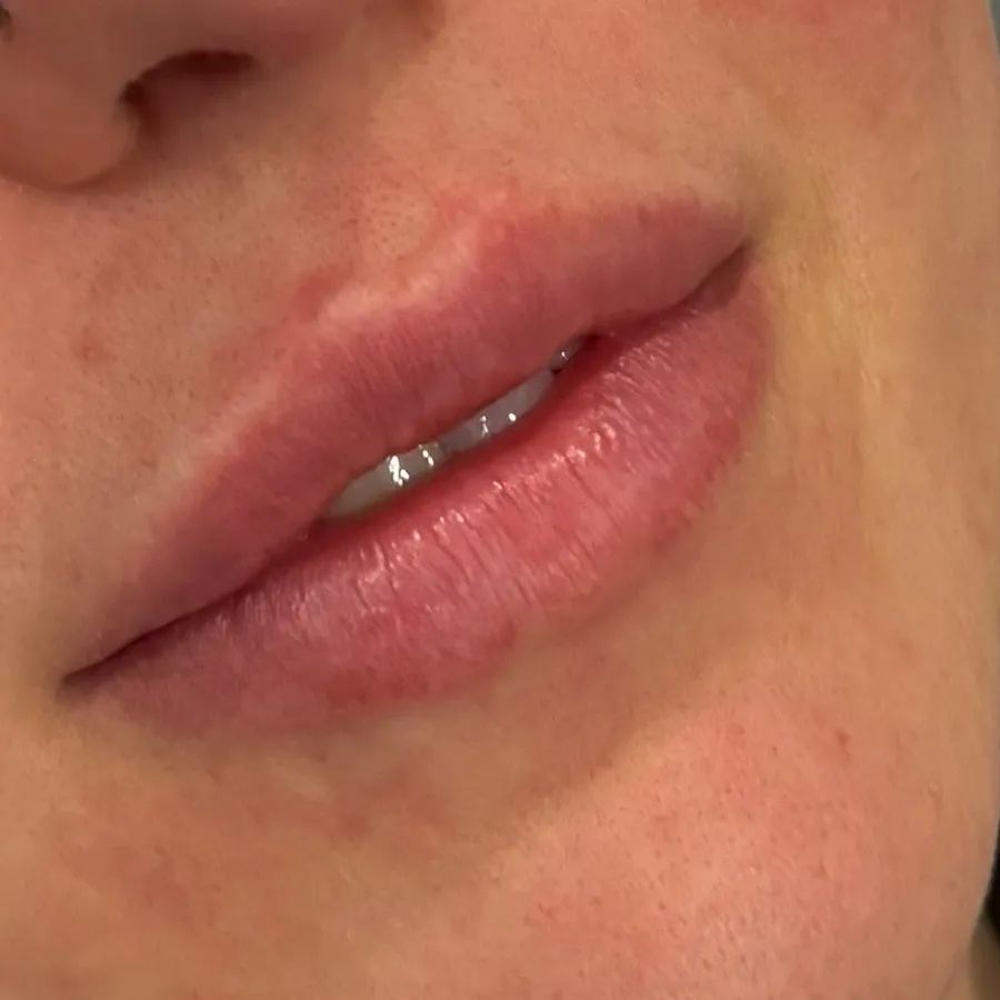 Before: lip filler