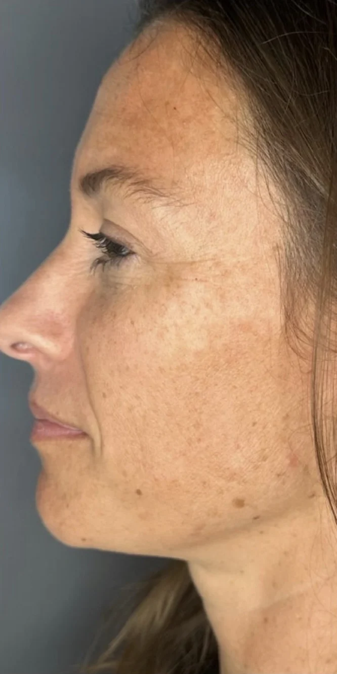 Before: sun damage