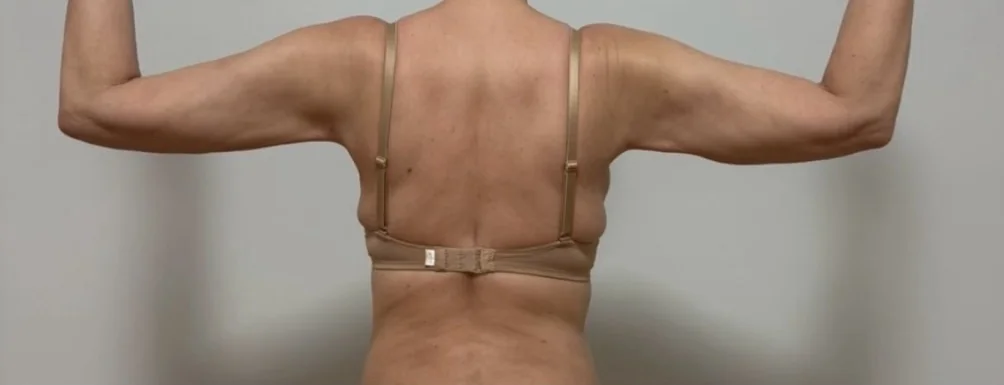 Before: upper arms, raised