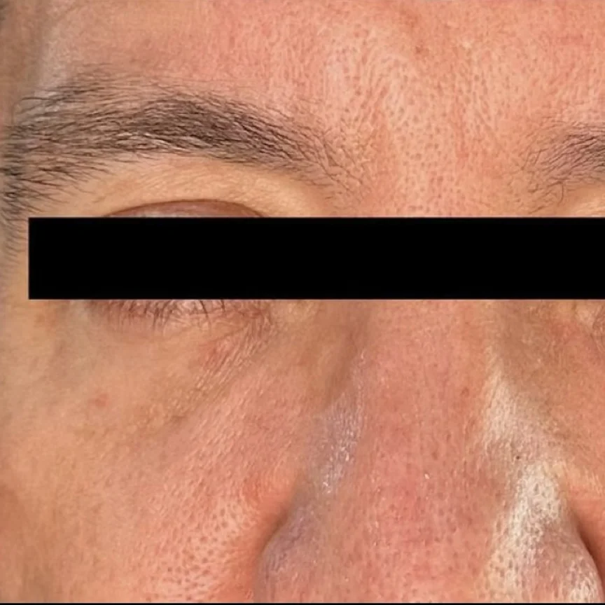 After: morpheus8 under eyes