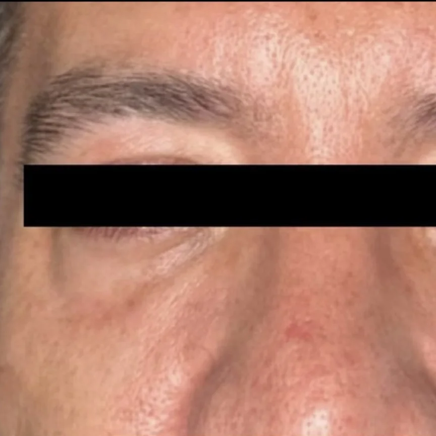 Before: morpheus8 under eyes