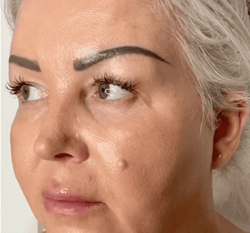 After: face